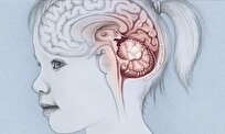 مزایای درمان تومورهای مغزی کودکان با رویکرد چند تخصصی